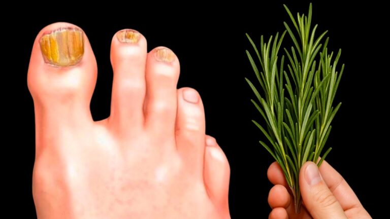 No lo vas a creer… el hongo desapareció en 1 día con este truco casero!